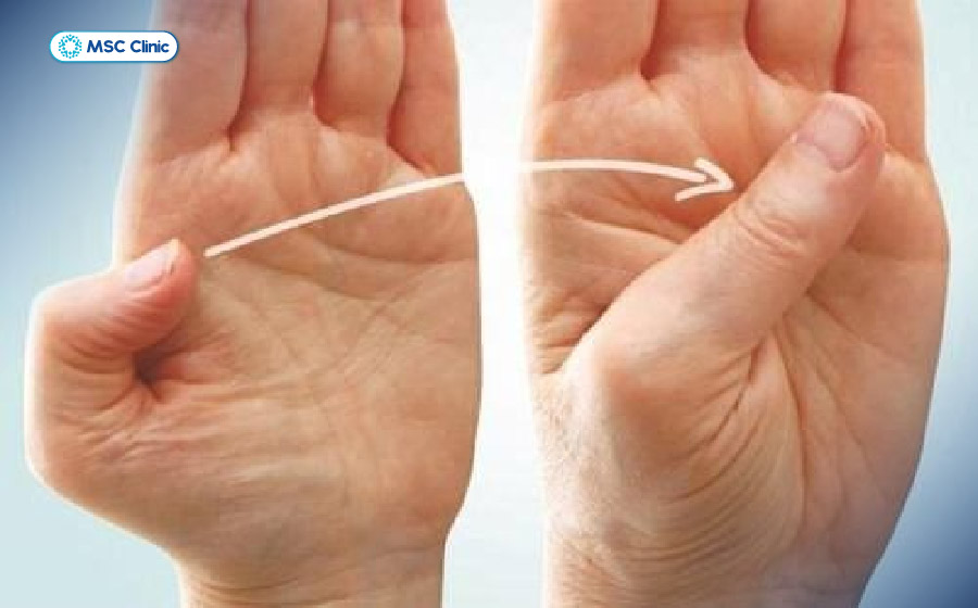 Hạn chế tầm vận động có thể là dấu hiệu của bong gân ngón tay