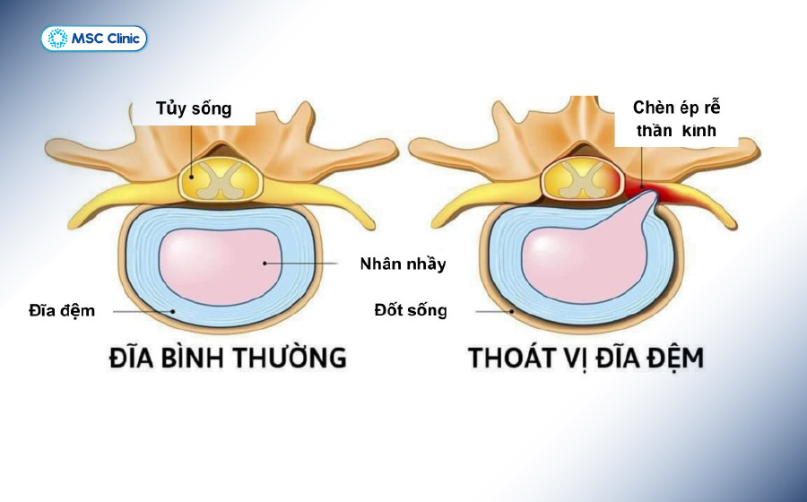 Hình ảnh so sánh đĩa đệm bình thường và thoát vị đĩa đệm