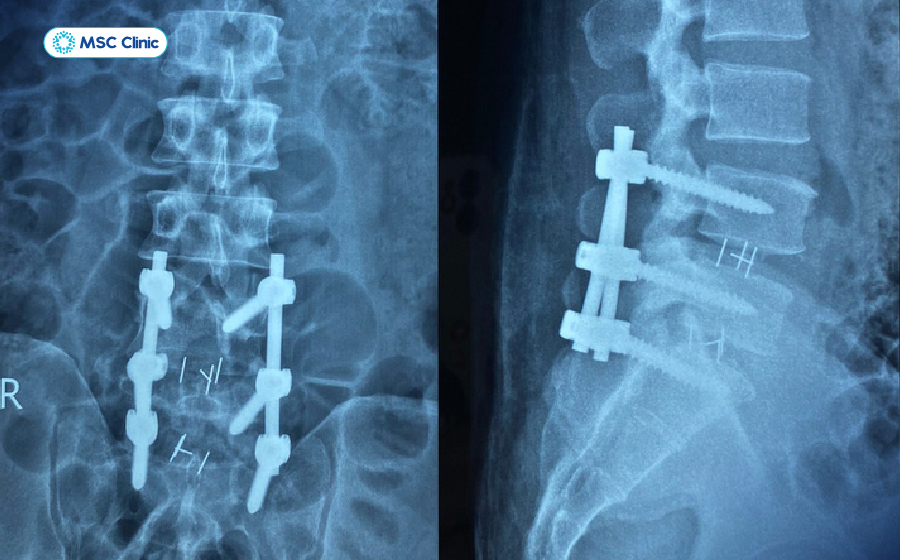 Hình ảnh X-quang sau phẫu thuật cố định cột sống dành cho các trường hợp nghiêm trọng