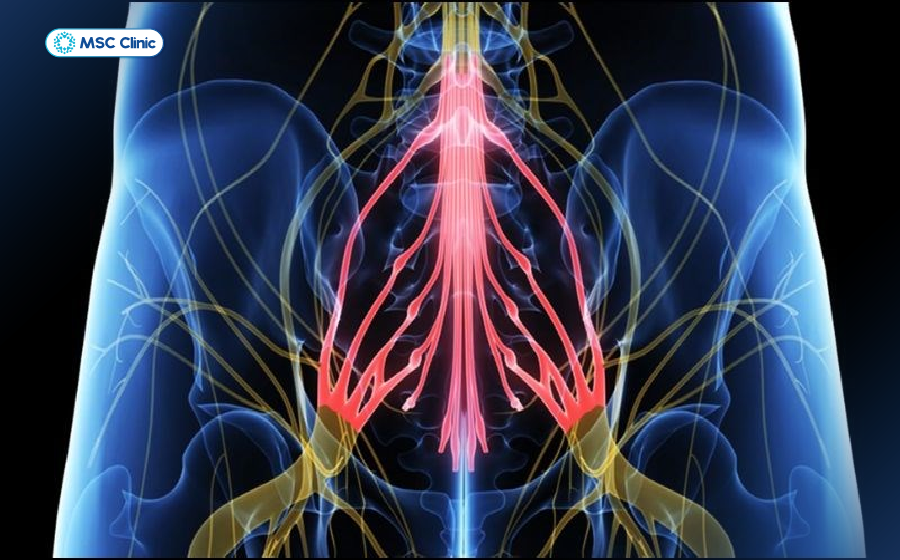 Hội chứng chùm đuôi ngựa là biến chứng nguy hiểm nếu đau thần kinh tọa không được điều trị kịp thời Hội chứng chùm đuôi ngựa là biến chứng nguy hiểm nếu đau thần kinh tọa không được điều trị kịp thời