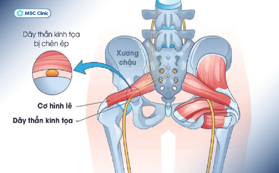 Hội chứng cơ hình lê gây áp lực lên dây thần kinh tọa Hội chứng cơ hình lê gây áp lực lên dây thần kinh tọa