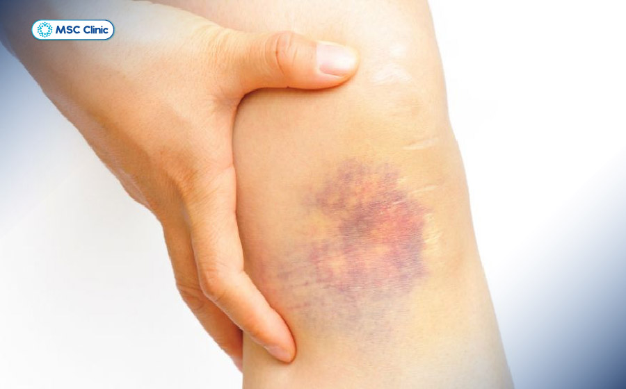 Bong gân đầu gối có các dấu hiệu nhận biết như sưng nề hoặc bầm tím
