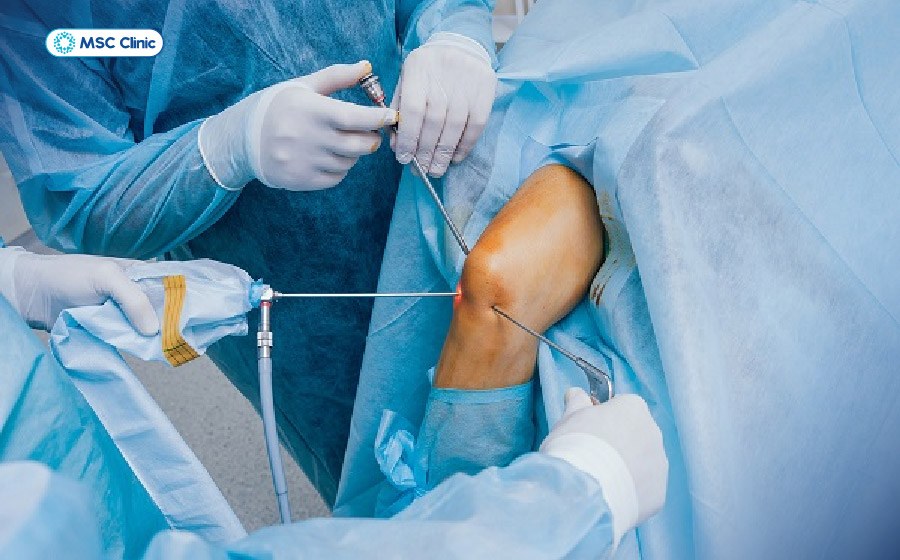 Phẫu thuật tái tạo dây chằng nếu điều trị nội khoa không xử lý được tổn thương