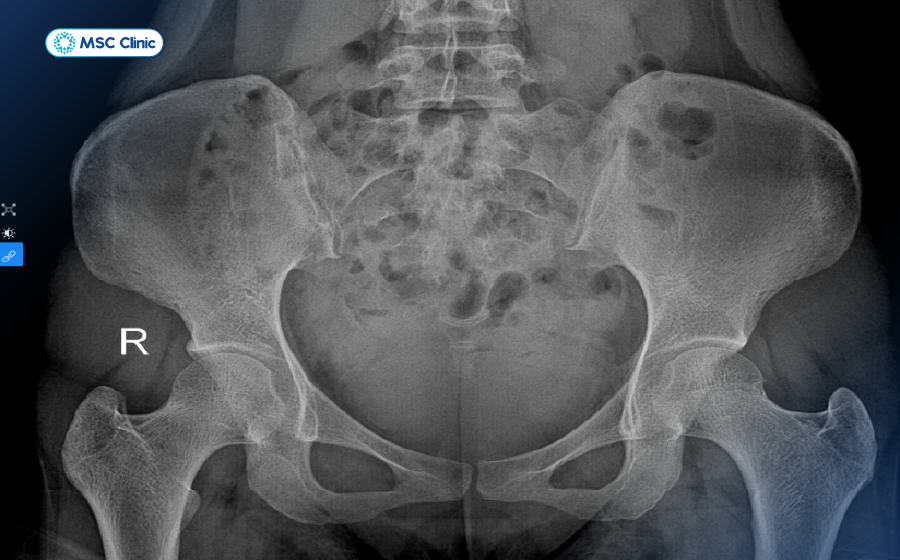 Phim X-quang giúp xác định có tình trạng gai xương chèn ép hay không Phim X-quang giúp xác định có tình trạng gai xương chèn ép hay không