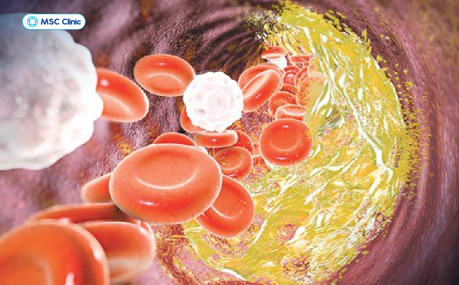 Rối loạn chuyển hóa gây tê tay chân, đau lưng và yếu cơ