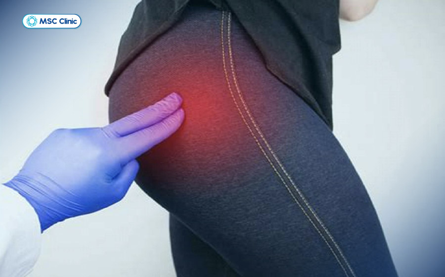Tê bì lan tỏa là triệu chứng điển hình của gai cột sống lưng
