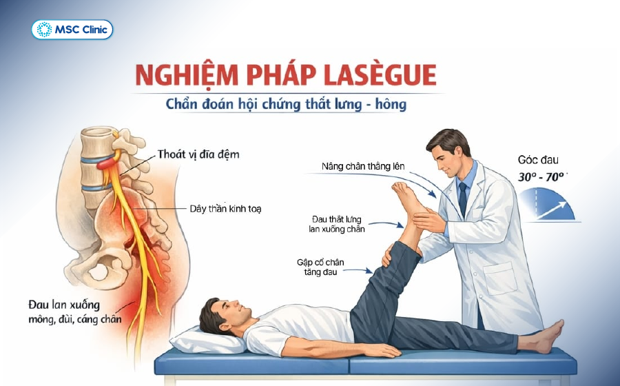 Thăm khám lâm sàng với nghiệm pháp Lasègue giúp bác sĩ bước đầu xác định khả năng tổn thương dây thần kinh Thăm khám lâm sàng với nghiệm pháp Lasègue giúp bác sĩ bước đầu xác định khả năng tổn thương dây thần kinh