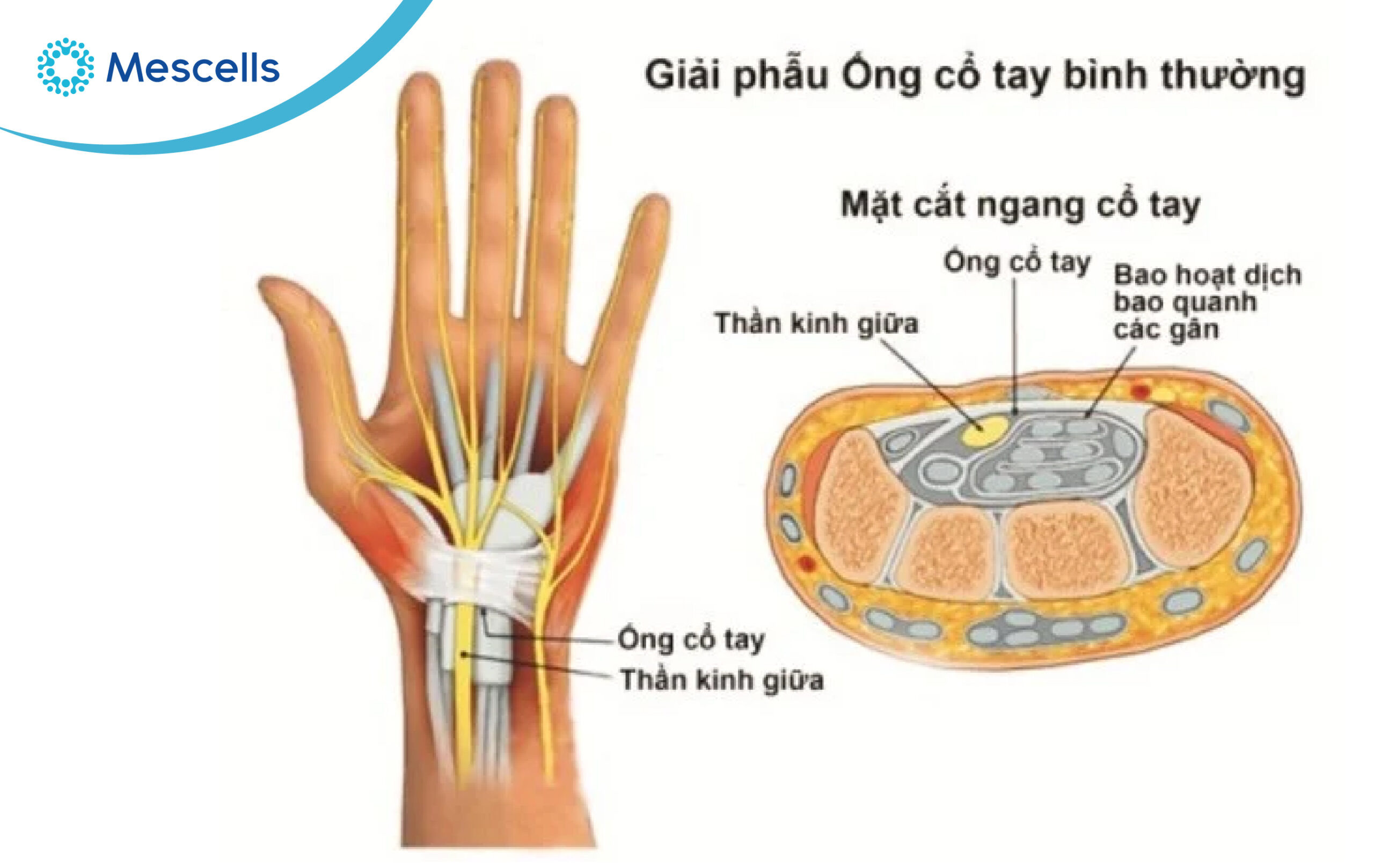 Thần kinh giữa nằm gần bao hoạt dịch là nguyên nhân khiến khu vực này dễ bị chèn ép Thần kinh giữa nằm gần bao hoạt dịch là nguyên nhân khiến khu vực này dễ bị chèn ép