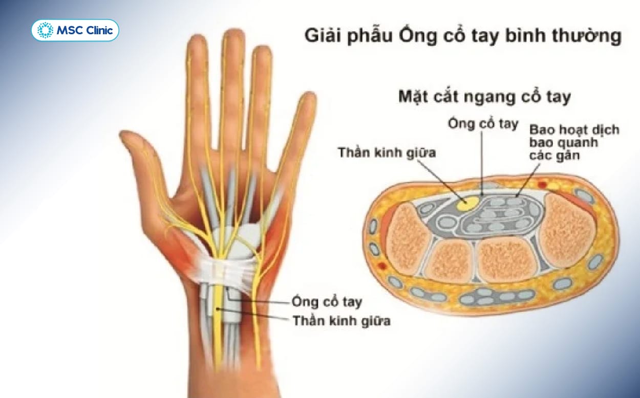 Thần kinh giữa nằm gần bao hoạt dịch là nguyên nhân khiến khu vực này dễ bị chèn ép