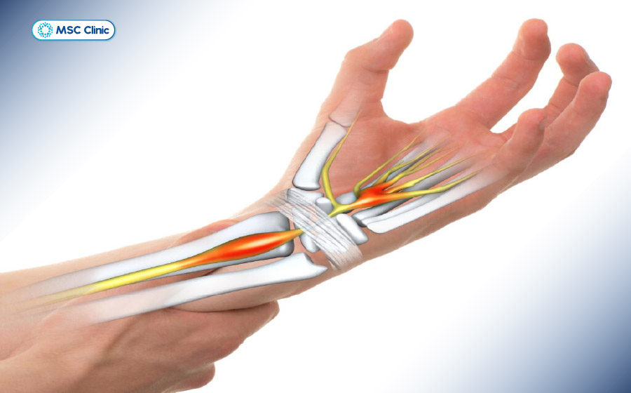 Theo thời gian, hội chứng này có thể làm teo cơ mô cái, khiến bàn tay yếu rõ rệt