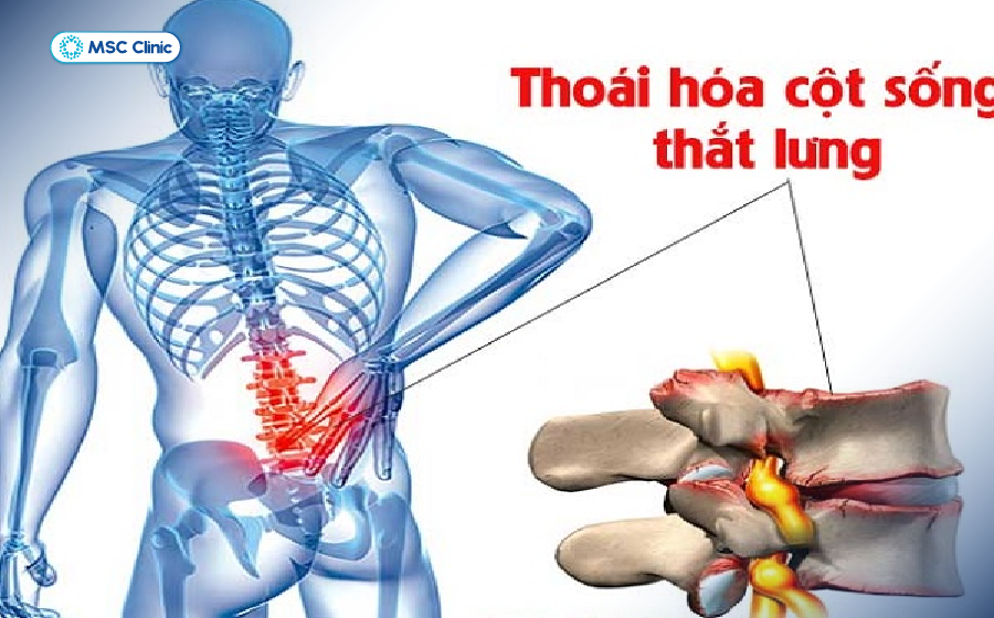 Thoái hóa cột sống tạo gai xương đâm vào rễ thần kinh Thoái hóa cột sống tạo gai xương đâm vào rễ thần kinh