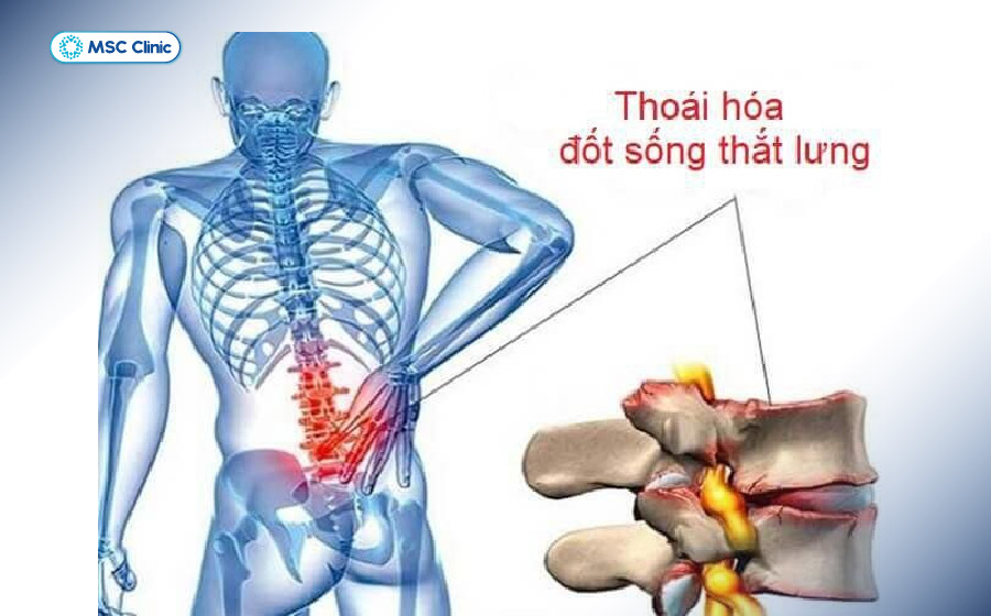 Thoái hóa cột sống thắt lưng là nguyên nhân gây gai cột sống