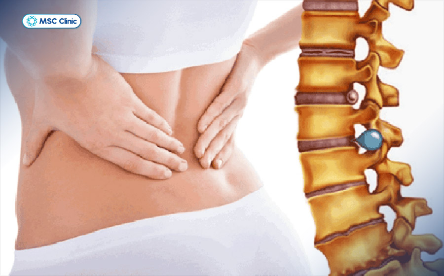 Thoát vị đĩa đệm cột sống có thể chèn ép dây thần kinh, gây đau cơ liên sườn