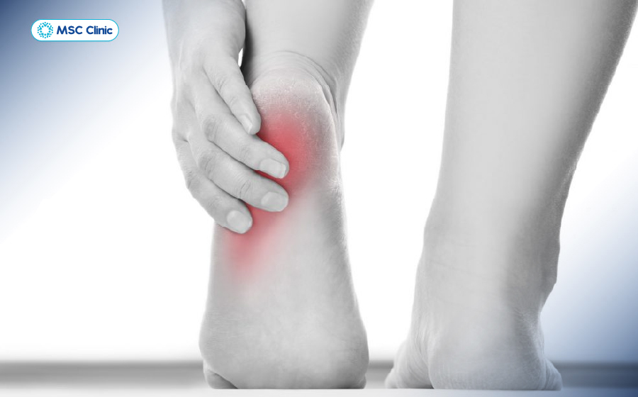 Tình trạng đau gót chân gây khó chịu tại vùng gót