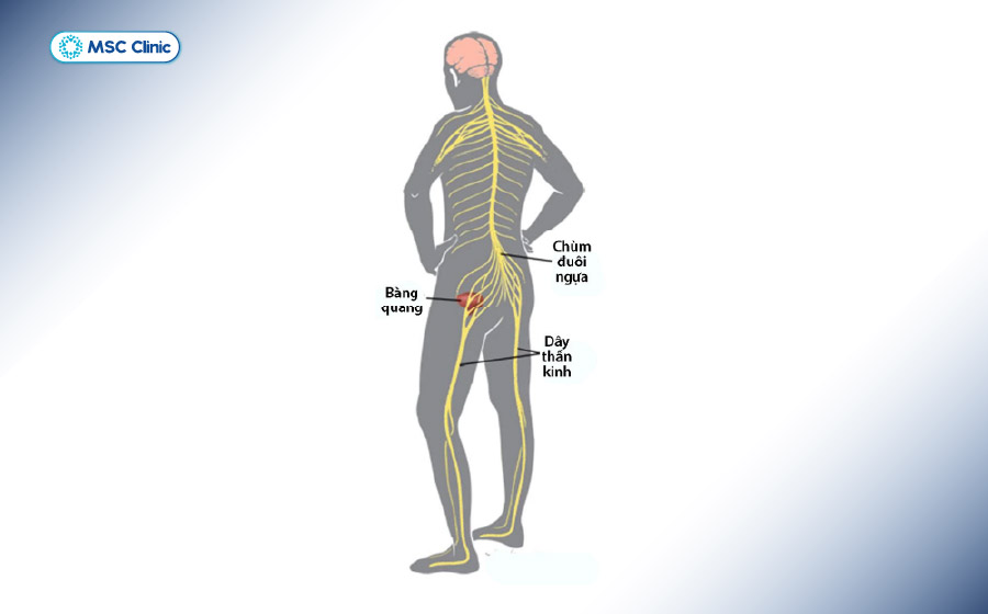Vị trí của hội chứng chùm đuôi ngựa