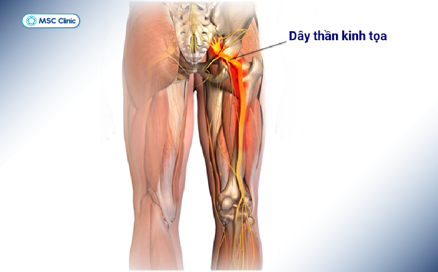 Vị trí dây thần kinh tọa Vị trí dây thần kinh tọa