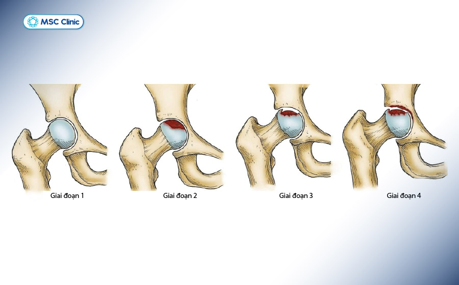 4 giai đoạn phát triển của hoại tử khớp háng