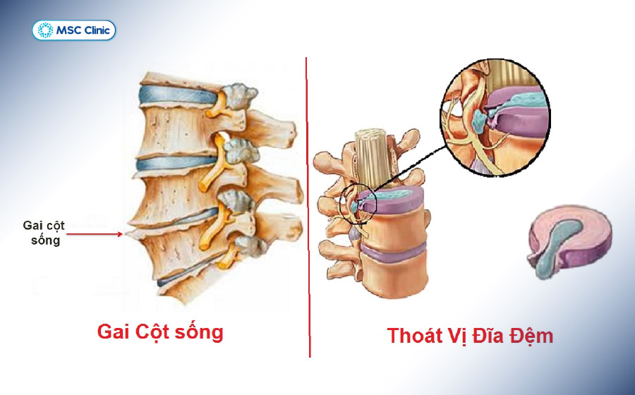Cơn đau gai đốt sống đi kèm thoát vị đĩa đệm sẽ tăng dần theo thời gian hoặc gây mất khả năng vận động