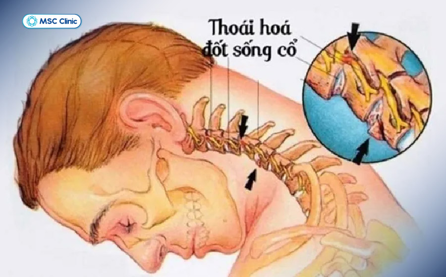 Thoái hoá cột sống cổ là một trong những nguyên nhân phổ biến gây gai đốt sống cổ