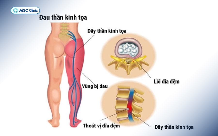 Bệnh lý đau thần kinh tọa là bệnh rất phổ biến trong lứa tuổi từ 30-50 Bệnh lý đau thần kinh tọa là bệnh rất phổ biến trong lứa tuổi từ 30-50