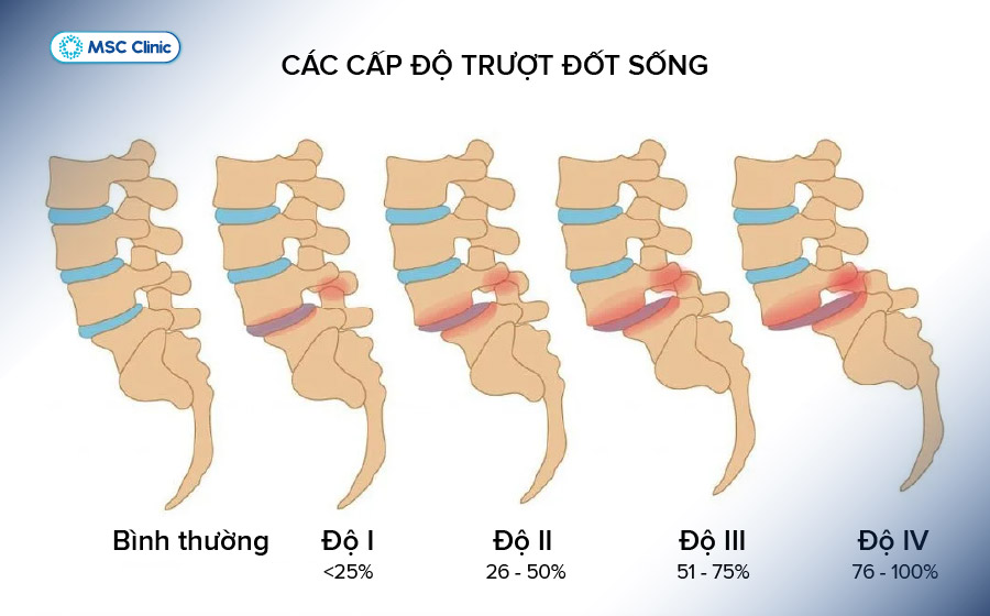 Các cấp độ trượt đốt sống