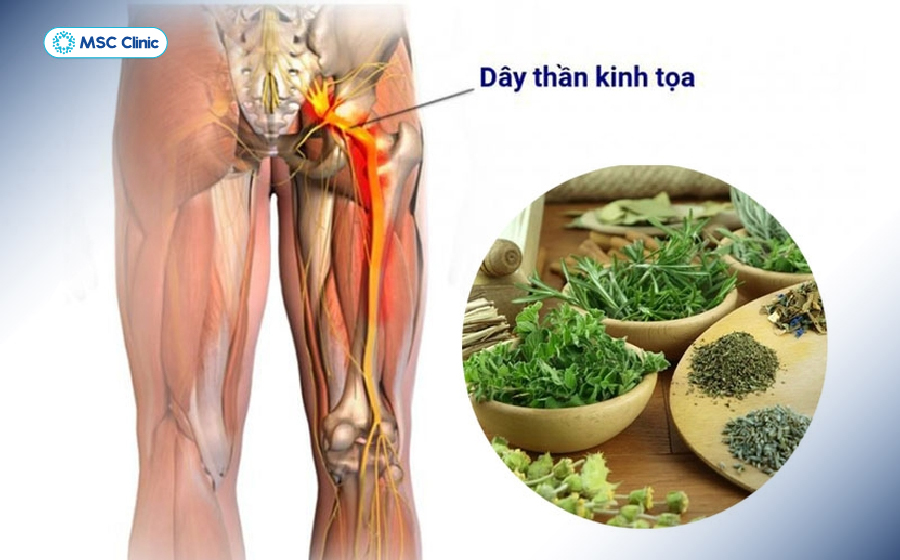 Các mẹo chữa đau thần kinh tọa chỉ áp dụng khi bệnh đang ở mức độ nhẹ đến trung bình Các mẹo chữa đau thần kinh tọa chỉ áp dụng khi bệnh đang ở mức độ nhẹ đến trung bình