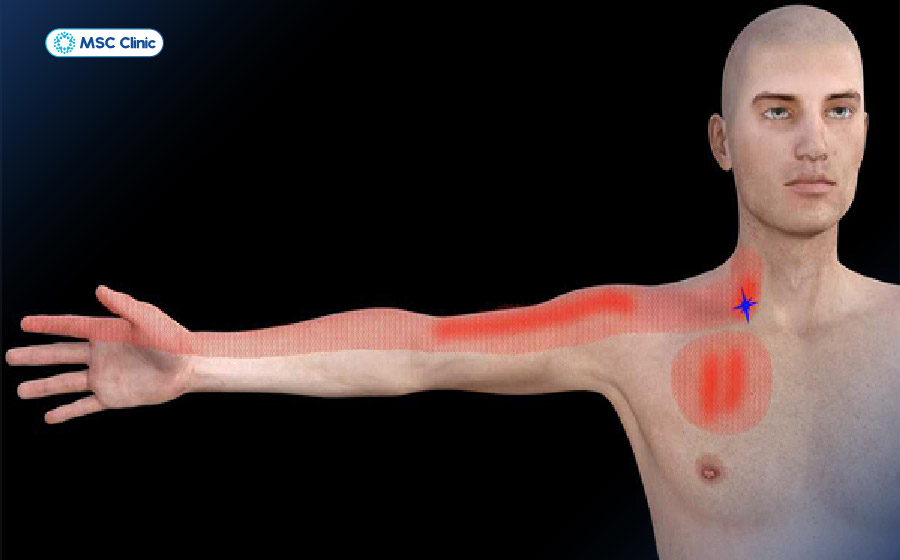 Đau cổ vai gáy có thể dẫn đến những cơn đau lan dọc cánh tay