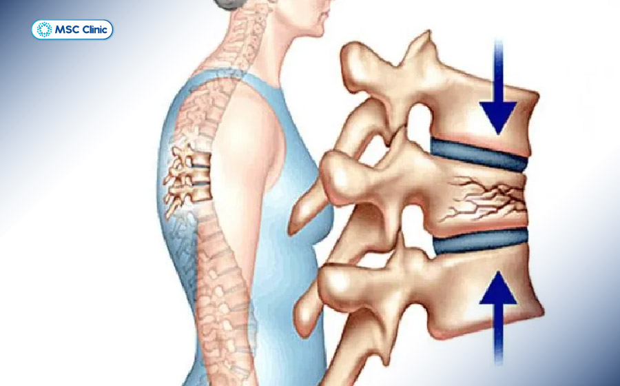 Đau cột sống thắt lưng là vị trí phổ biến nhất của xẹp đốt sống