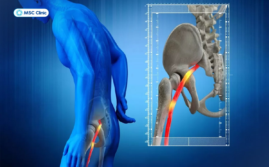 Đau thần kinh tọa gây ra cảm giác khó chịu, mệt mỏi Đau thần kinh tọa gây ra cảm giác khó chịu, mệt mỏi