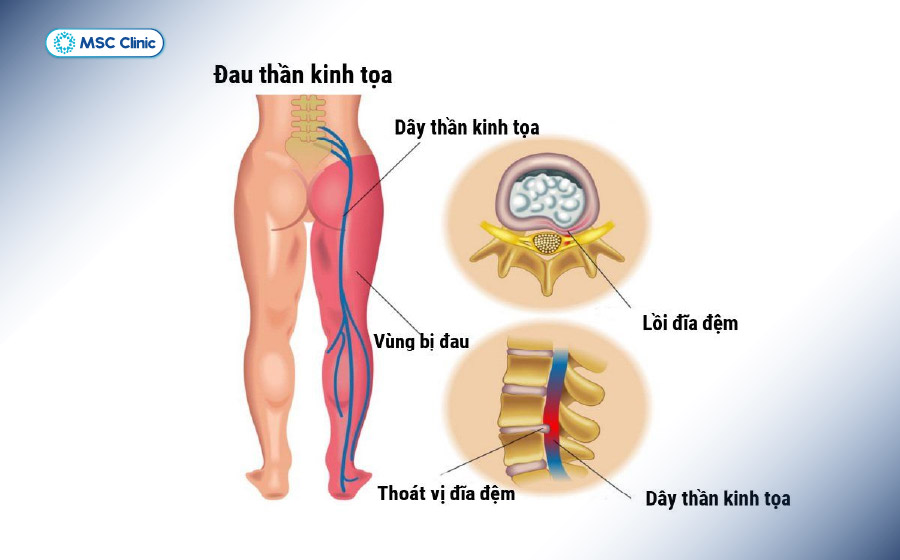 Dây thần kinh bị chèn ép ở cột sống gây hiện tượng đau lan dọc từ mông xuống chân