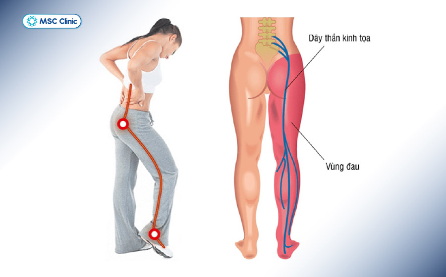 Dây thần kinh tọa là dây thần kinh dài nhất cơ thể nên cơn đau ảnh hưởng rộng Dây thần kinh tọa là dây thần kinh dài nhất cơ thể nên cơn đau ảnh hưởng rộng