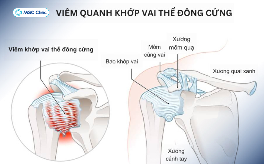 Đông cứng khớp vai khiến những chuyển động vùng vai gần như không thực hiện được