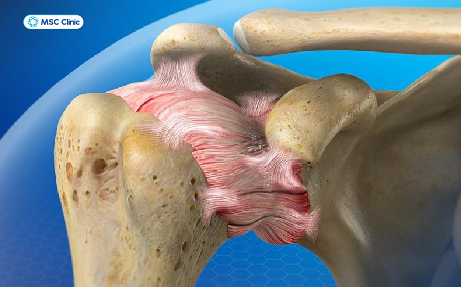 Đông cứng khớp vai làm người bệnh mất dần tầm vận động Đông cứng khớp vai làm người bệnh mất dần tầm vận động