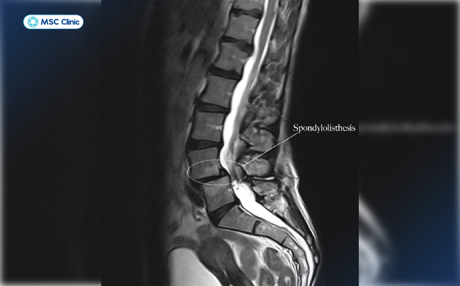 Hình ảnh trượt đốt sống trên phim chụp MRI