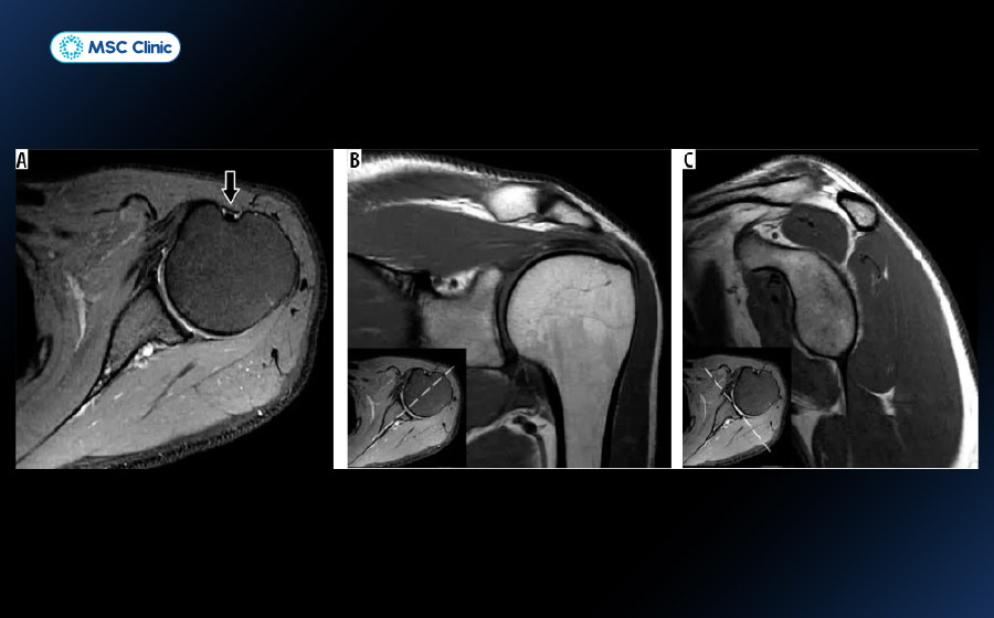 Khớp vai trên hình chụp MRI Khớp vai trên hình chụp MRI