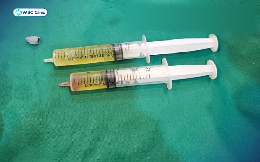 Lượng dịch dư thừa tại khớp cổ tay sau khi hút dịch
