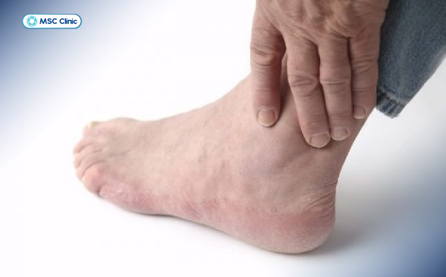Màng hoạt dịch khi viêm có thể gây tràn dịch khớp cổ chân hoặc ngược lại