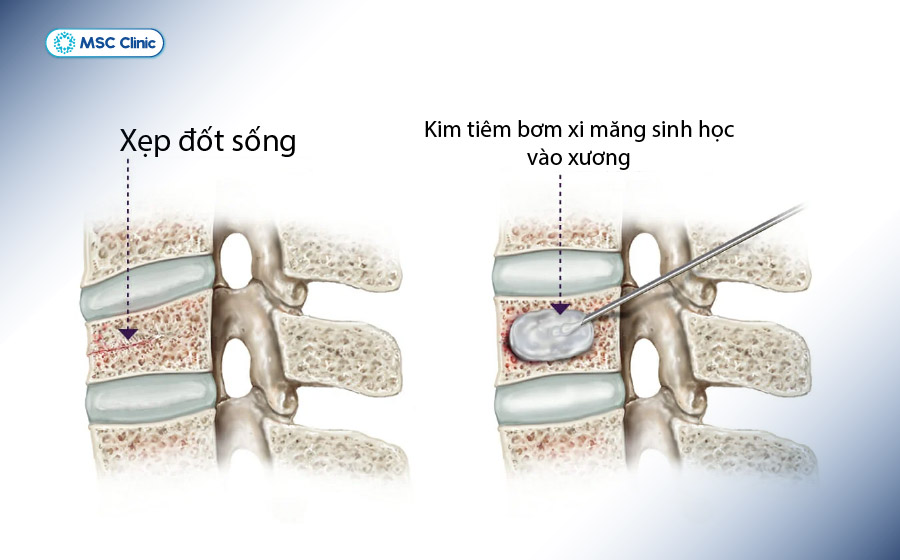 Phương pháp bơm xi măng sinh học vào thân đốt sống để điều trị gãy xẹp và giảm đau nhanh chóng