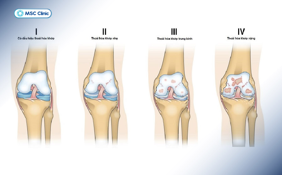Quá trình bào mòn sụn xương đầu khớp dẫn đến bệnh lý thoái hoá khớp gối