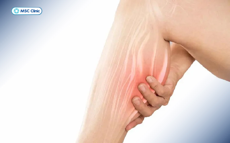 Sưng tấy, đau nhức vùng bắp chân là dấu hiệu thường gặp khi bị căng cơ bắp chân