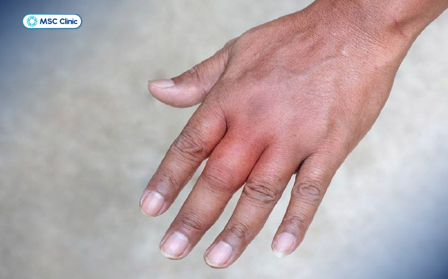 Sưng tấy rõ rệt, quanh khớp đỏ ửng là dấu hiệu dễ thấy khi bị tràn dịch khớp ngón tay Sưng tấy rõ rệt, quanh khớp đỏ ửng là dấu hiệu dễ thấy khi bị tràn dịch khớp ngón tay