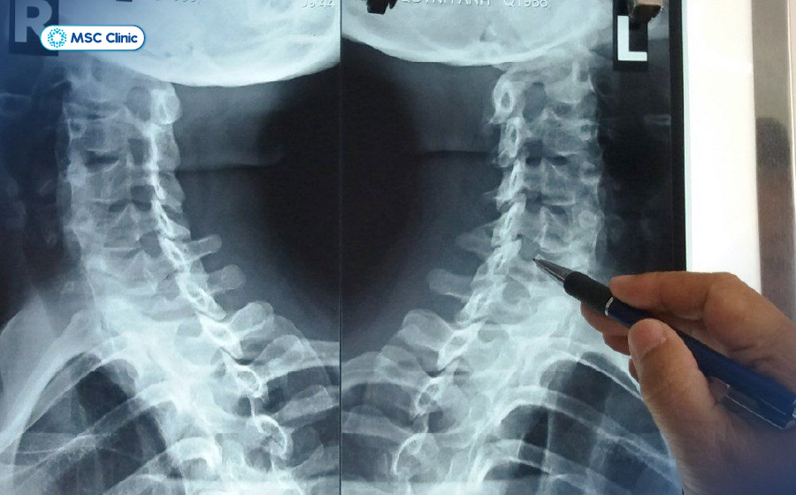 Thăm khám hình ảnh giúp chẩn đoán chính xác nguyên nhân dẫn đến đau cổ vai gáy