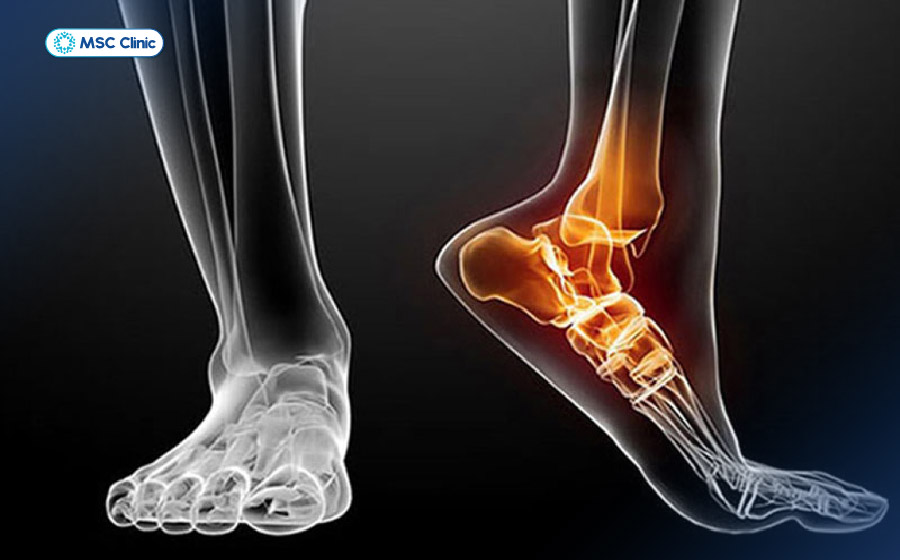 Thoái hóa khớp cổ chân gây đau, cứng khớp và hạn chế vận động