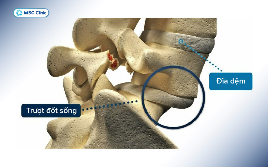 Thoái hóa khớp do tuổi tác dễ gây ra trượt đốt sống
