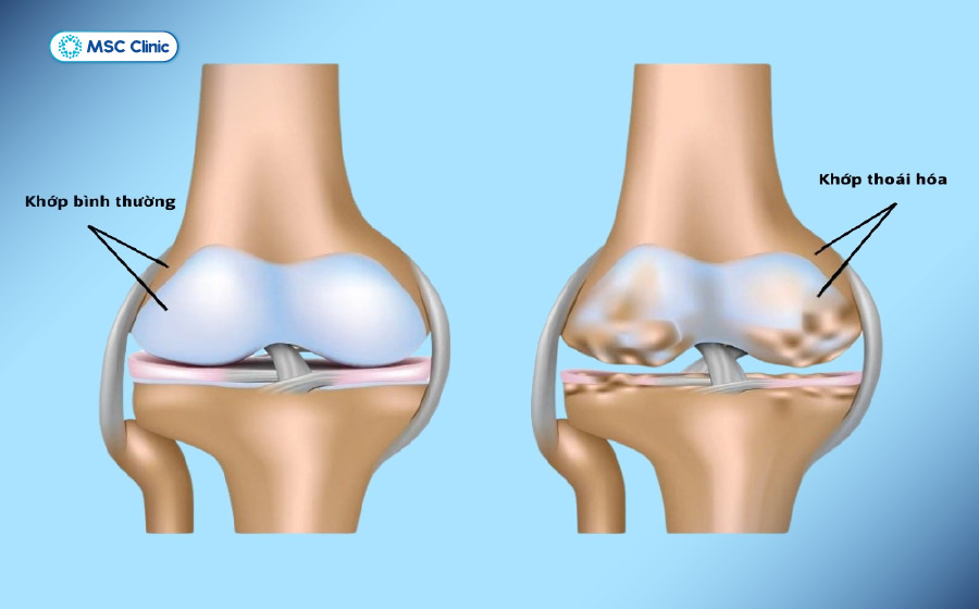 Thoái hóa khớp gối là bệnh lý rất phổ biến hiện nay