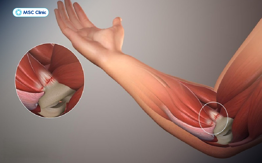 Thoái hoá khớp khuỷu tay là một trong những nguyên nhân gây tràn dịch khớp khuỷu tay Thoái hoá khớp khuỷu tay là một trong những nguyên nhân gây tràn dịch khớp khuỷu tay