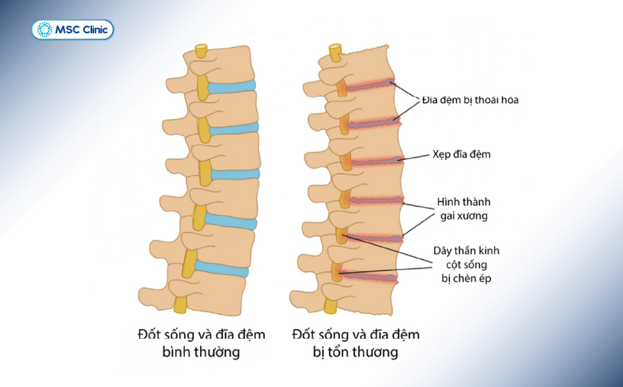 Thoát vị đĩa đệm là một trong những nguyên nhân phổ biến gây đau lưng