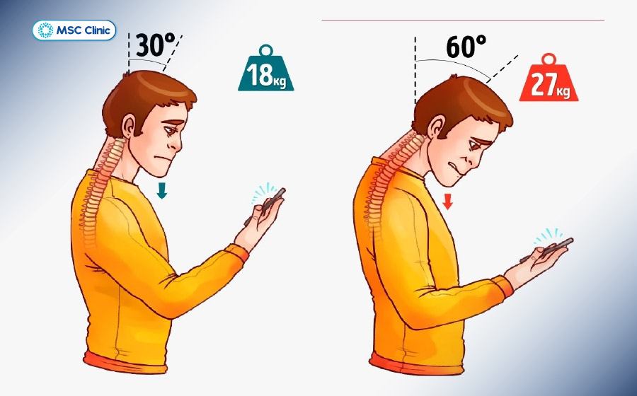 Thói quen cúi đầu được cho là một nguyên nhân phổ biến dẫn đến đau cổ vai gáy