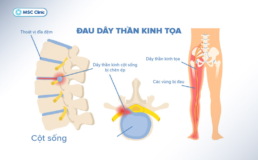 Tình trạng đau thần kinh tọa và vị trí gây đau