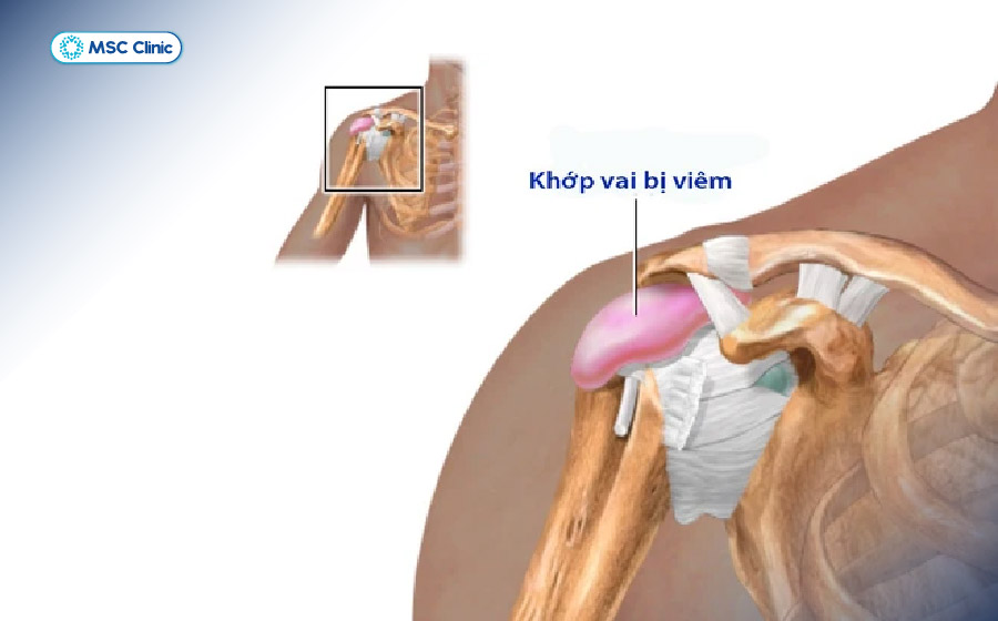 Tình trạng viêm khớp vai (đặc biệt ở bên trái) có thể gây đau tại chỗ và lan lên vùng cổ, gáy